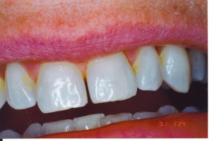 diastema            